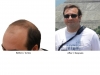 hair-transplant-photo-100