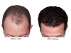 hair-transplant-photo-101