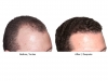 hair-transplant-photo-102