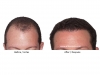 hair-transplant-photo-103