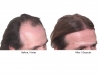 hair-transplant-photo-104