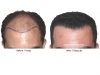 hair-transplant-photo-106