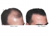 hair-transplant-photo-107
