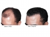 hair-transplant-photo-108