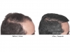 hair-transplant-photo-110