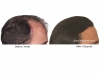 hair-transplant-photo-111