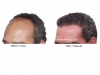 hair-transplant-photo-112
