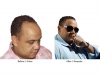 hair-transplant-photo-114