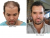 hair-transplant-photo-115