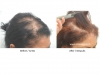 hair-transplant-photo-116