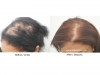 hair-transplant-photo-117