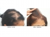 hair-transplant-photo-118