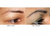 hair-transplant-photo-120