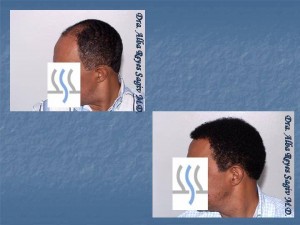 Ethnic Hair Transplant