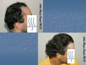 Trasplante de cabello étnico