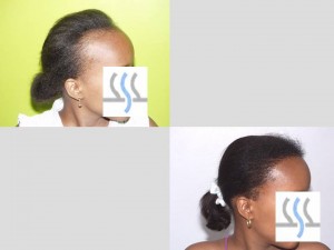 Female Hair Restoration