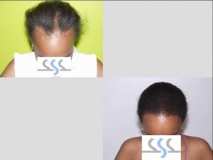 Ethnic Hair Transplant
